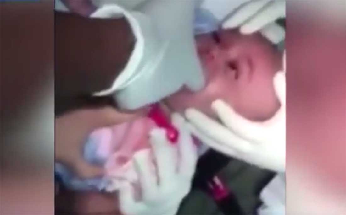Arts redt leven baby die bijna stikt in ingeslikt horloge