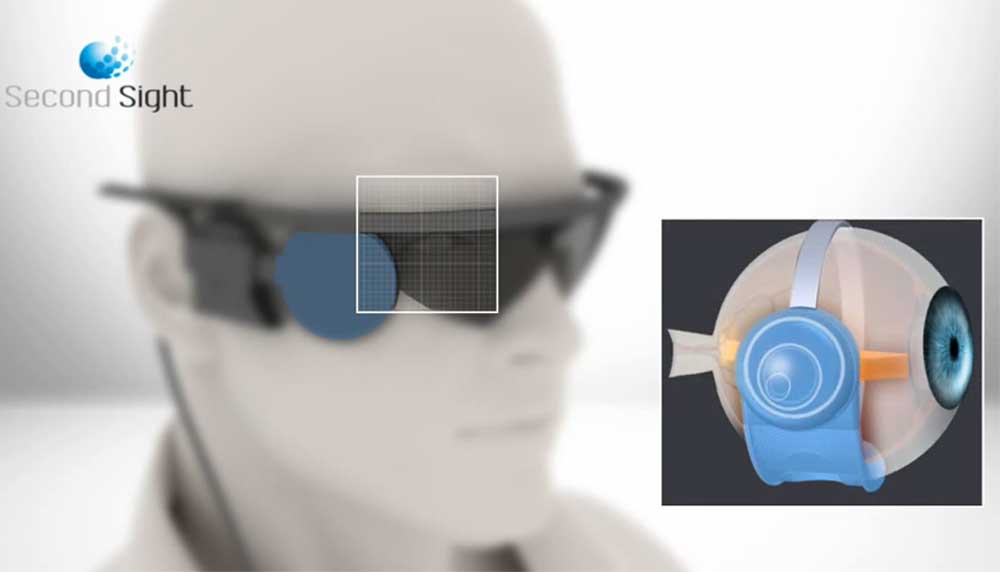 Foto van oog blind bril chip | Oogziekenhuis Zonnestraal