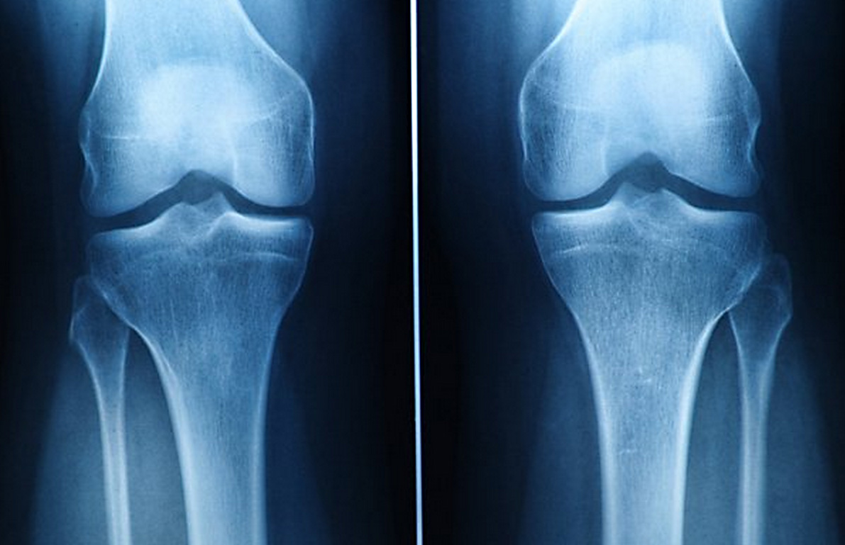 Hoop voor artrosepatiënten, UT maakt uit stamcellen blijvend kraakbeen 