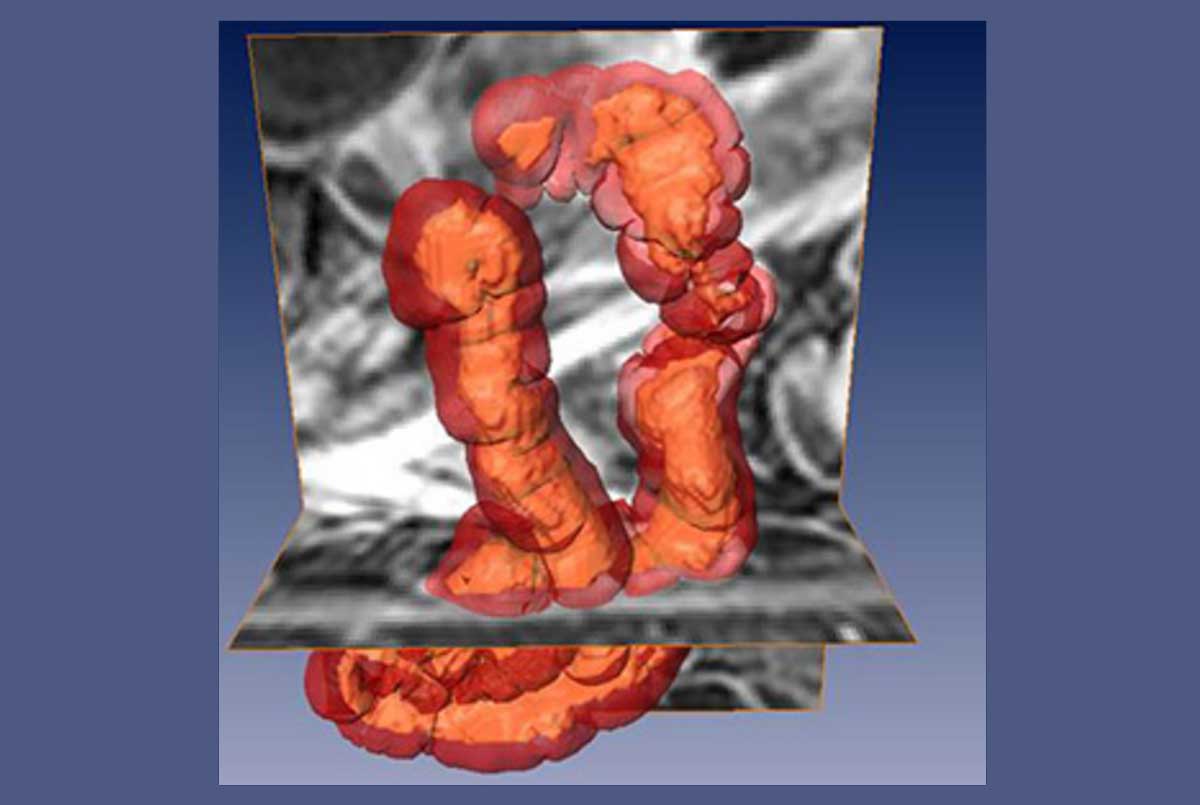 Beter zicht op de ziekte van Crohn via bewerkte MRI-beelden