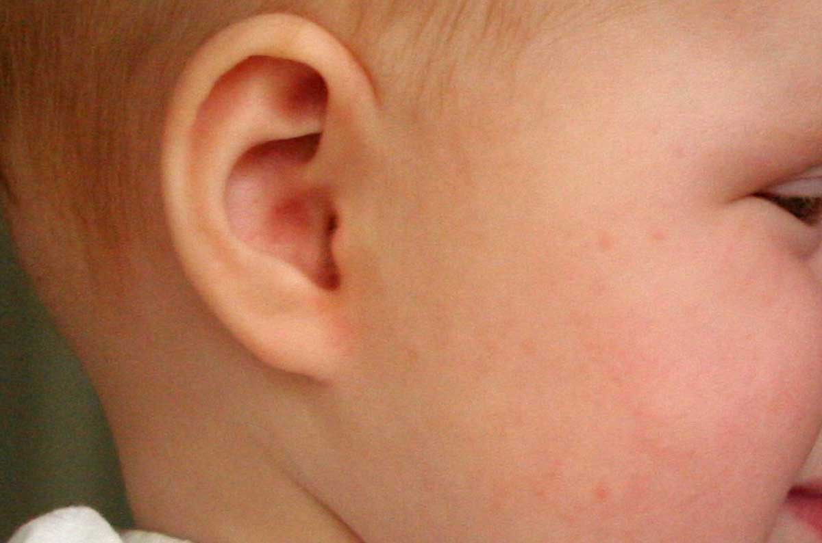 Krijgen van oorontsteking is bij kinderen erfelijk bepaald