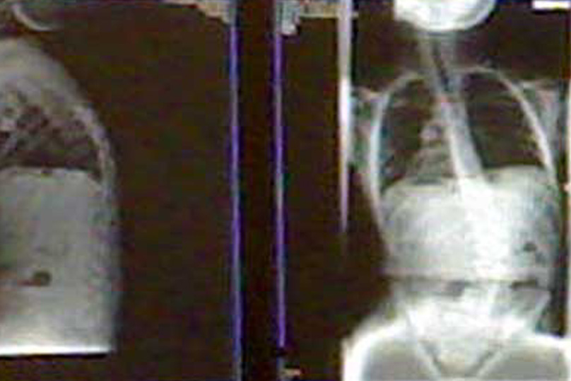 röntgenfoto-longen 