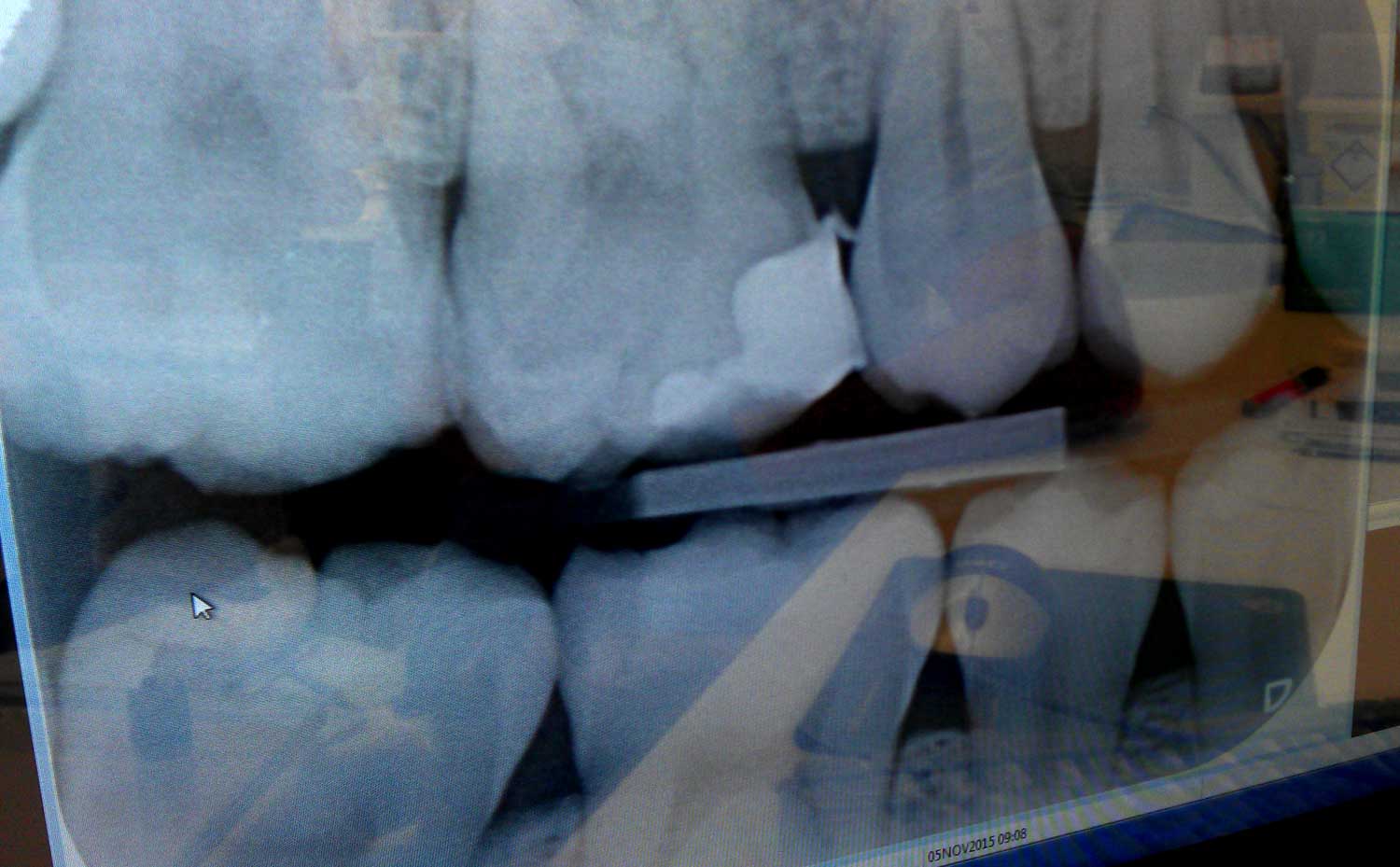 röntgenfoto-kiezen-gebit