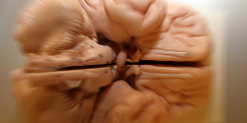 alzheimer-hersenen