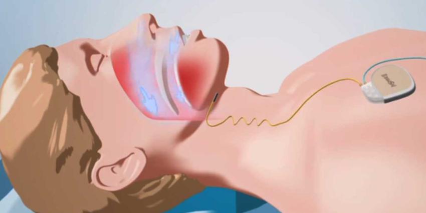Ernstige vorm van apneu te behandelen met tongzenuwstimulator 