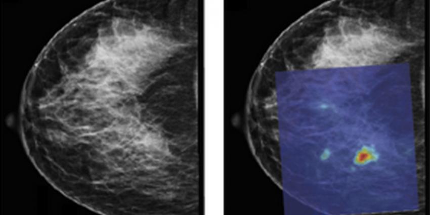 Belangrijke stap borstkankeronderzoek Universiteit Twente