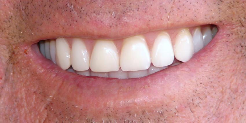 Kunstgebit in twee stukken na mishandeling