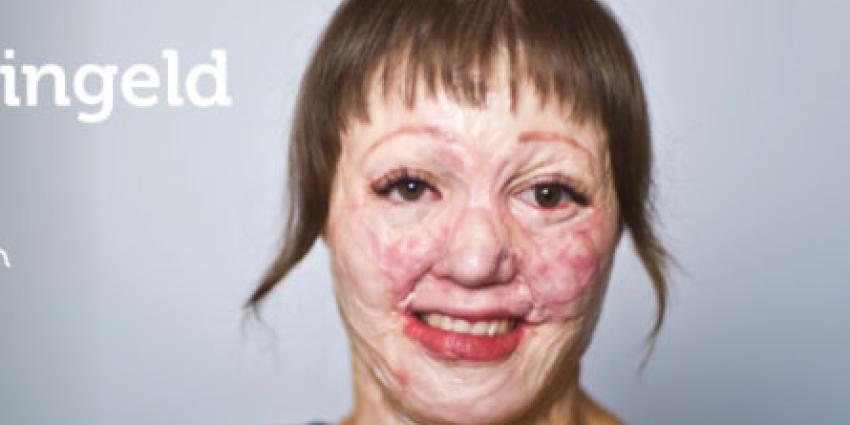 Facebook zegt sorry voor weigeren advertentie brandwondenstichting