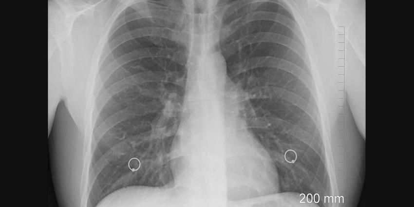 Nederland telt toename tuberculosepatiënten 