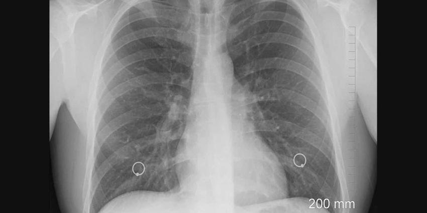 Nederland telt toename tuberculosepatiënten 
