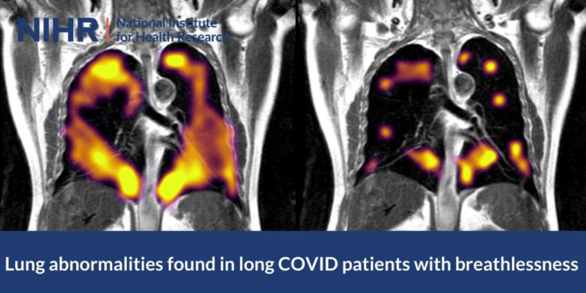 Afwijkingen in longen van langdurige Covid-patiënten met kortademigheid