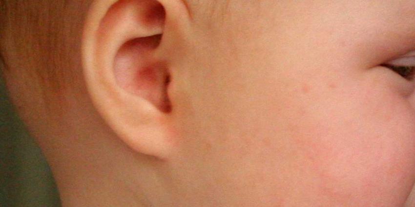 Krijgen van oorontsteking is bij kinderen erfelijk bepaald