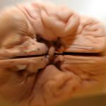 alzheimer-hersenen