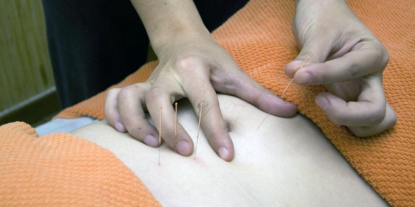 Foto van acupunctuur