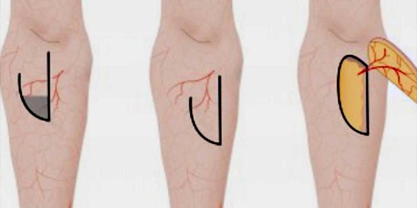 Zorgverzekeraars en overheid weigeren vergoeding behandeling brandwondenpatiënt