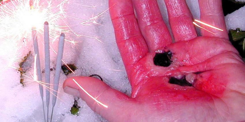 Brandwondencentrum: Oud & Nieuw gevaarlijkste 2 dagen van het jaar 