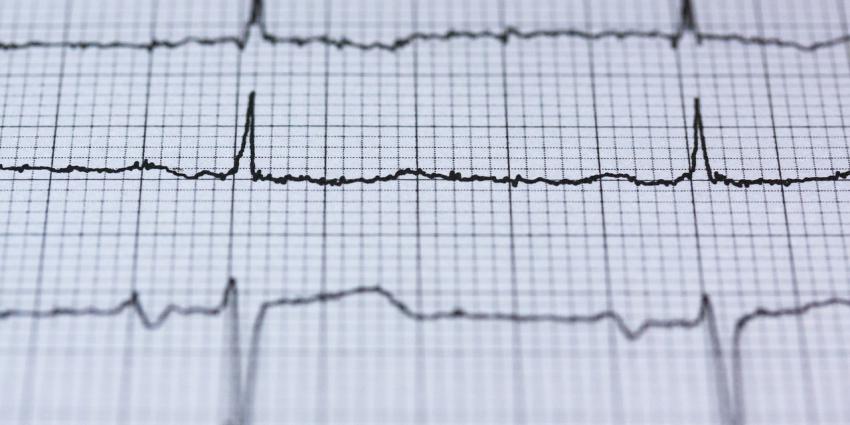 ECG