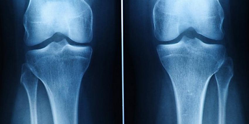 Hoop voor artrosepatiënten, UT maakt uit stamcellen blijvend kraakbeen 
