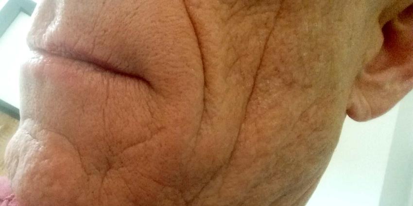  RIVM: tijdelijke rimpelvullers zijn niet schadelijk