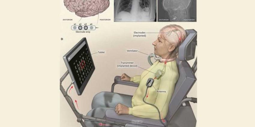 Verlamde ALS-patiënt stuurt spraakcomputer aan met haar gedachten