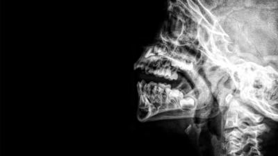 rontgen-schedel-nek-gebit