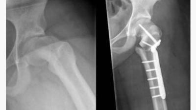 Meisje (13) krijgt ‘3D-heup’ 