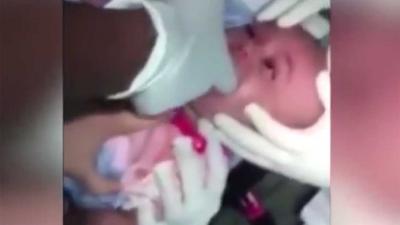 Arts redt leven baby die bijna stikt in ingeslikt horloge