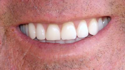 Kunstgebit in twee stukken na mishandeling