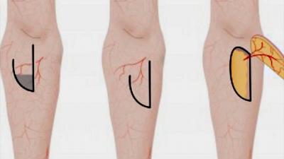 Nieuwe operatietechniek helpt tegen 'samentrekken' litteken door brandwond