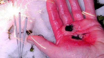 Brandwondencentrum: Oud & Nieuw gevaarlijkste 2 dagen van het jaar 