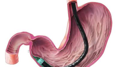 Pylorus klieven via de endoscoop primeur voor Nederland