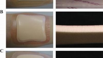 Speciale pleisters kunnen decubitus verminderen