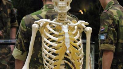 Tien nieuwe genen voor verstandelijke beperkingen ontdekt