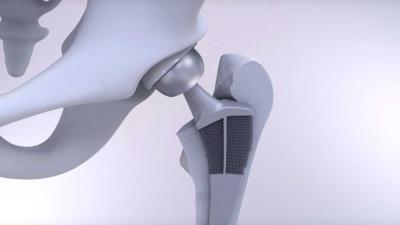 Loslatende heupimplantaten over met nieuw 3D geprint meta-implantaat