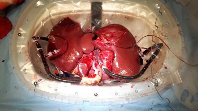 Nieuwe methodes om leverontsteking te diagnosticeren en behandelen