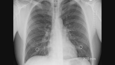 Nederland telt toename tuberculosepatiënten 