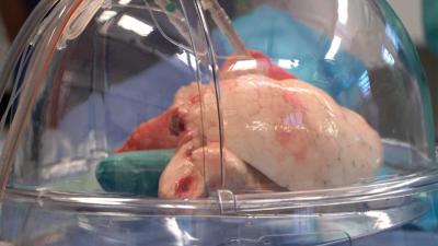 long-perfusie-donor-transplantatie