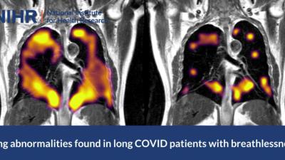 Afwijkingen in longen van langdurige Covid-patiënten met kortademigheid