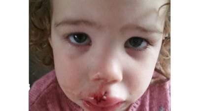 Meisje (2) in gezicht gebeten door hond