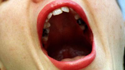 Gemuteerd gen veroorzaakt chronisch slechte adem