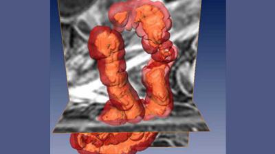 Beter zicht op de ziekte van Crohn via bewerkte MRI-beelden