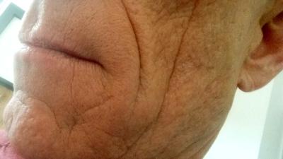  RIVM: tijdelijke rimpelvullers zijn niet schadelijk