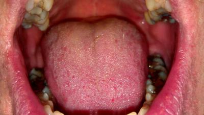 keel-mond-speeksel-tong-kiezen