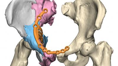 UMCG voert eerste bekkenreconstructie met 3D-technologie uit